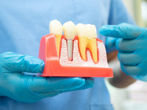 implantes dentários