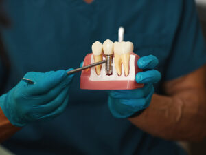 implantes dentários