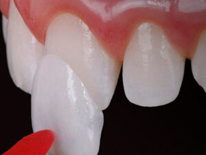 lentes de contato dental