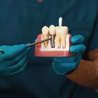 implantes dentários