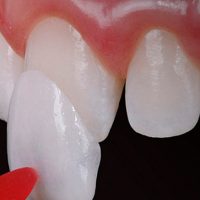 lentes de contato dental